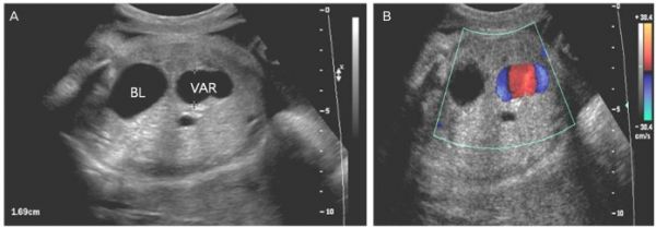 Fetal intra-abdominal umbilical vein varix ultrasound 01.jpg