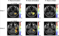Fig 32 pre-stimulus low-frequency activity only in right cerebellar hemisphere Z5076158
