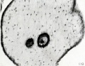 Fig. 119. Epithelial vesicles within the stroma. No. 872. X180.