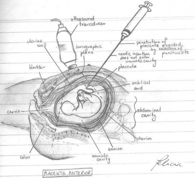 Placenta Anterior