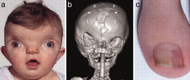 File:Craniofrontonasal syndrome.jpg