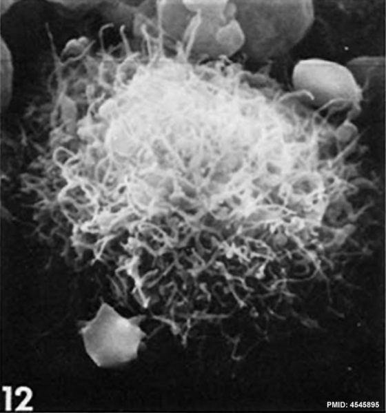 File:Lymphocyte rosettes EM012.jpg
