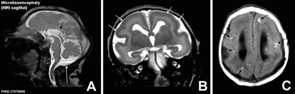 Microlissencephaly MRI-01.jpg