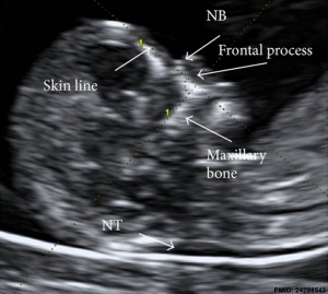 Ultrasound nuchal translucency
