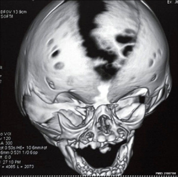 File:Skull vault defect and midface hypoplasia.jpg