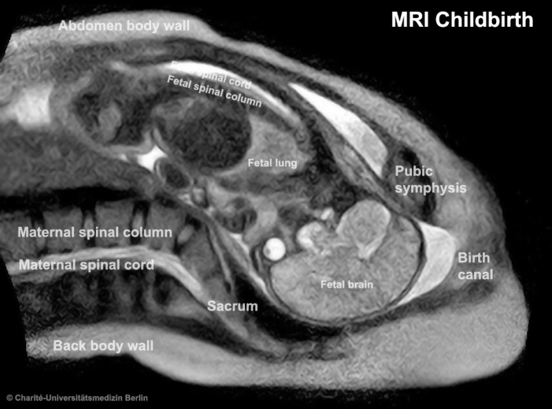 File:Birth- Magnetic Resonance Imaging 02.jpg