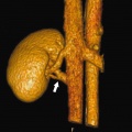 Supernumerary right renal vein 1