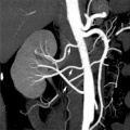 Multiple renal arteries