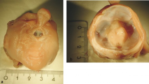 Human holoprosencephaly cyclopia dissection.jpg