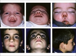 Image shows a child before and after surgery to repair a bilateral cleft lip