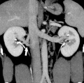 Supernumerary right renal vein