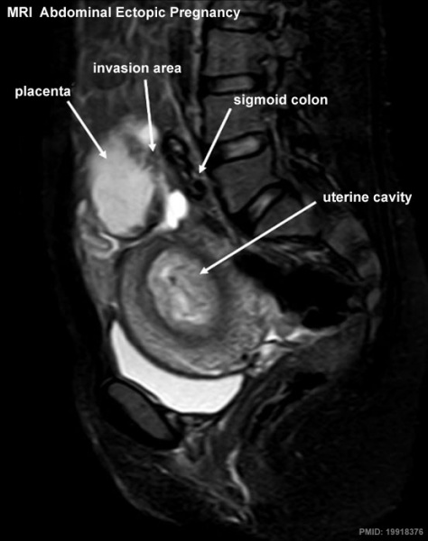 File:Abdominal ectopic pregnancy MRI.jpg