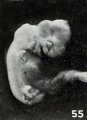 Figs. 52-63. Illustrating the absence of fundamental differences between the group of fetus compressus and grade 3 of the normal specimens. No. 852 (fig. 55) normal. X2.