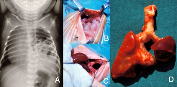 Congenital diaphragmatic hernia 01.jpg