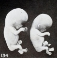 Fig. 134. Twin fetuses, No. 2250a and 6, a case of hydatiform degeneration. XI.