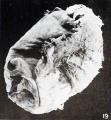 Fig. 19. External appearance of chorion containing small nodular twin. No. 7886.