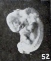 Figs. 52-63. Illustrating the absence of fundamental differences between the group of fetus compressus and grade 3 of the normal specimens. No. 12956 (fig. 52) pathological.