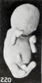 Fig. 220. A fetus showing marked clubbing of the extremities and obliteration of the features. No. 1958. X0.87.
