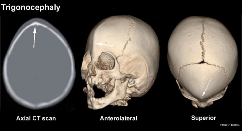 File:Skull CT abnormal 07.jpg