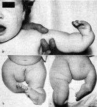 Thalidomide affected Infant