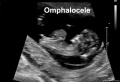 Omphalocele 01 icon.jpg