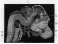 Fig 4. Shows medial aspect of model of brain