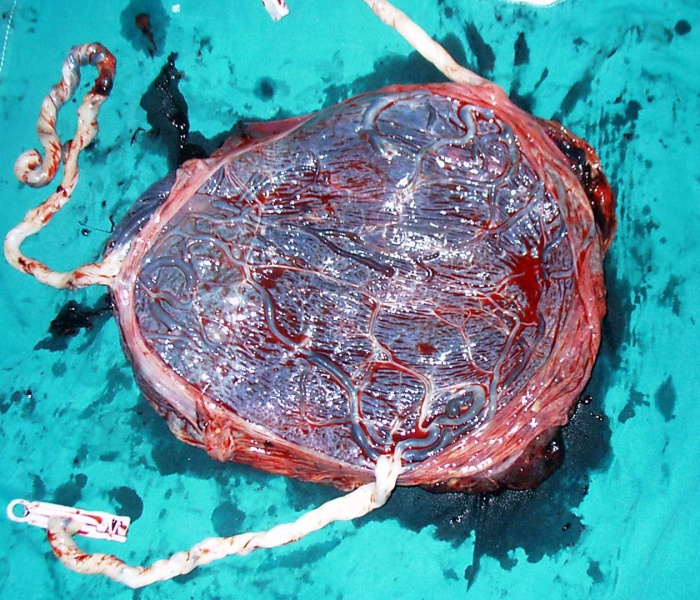 File:Triplet placenta.jpg