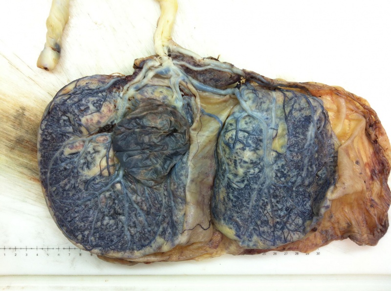 File:Bilobed placenta with velamentous cord insertion.jpg