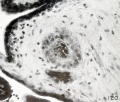 Fig. 120. Extremity of an epithelial vesicle within the stroma, same specimen. X300.