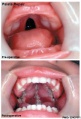 Palatoplasty - surgical repair of the palate