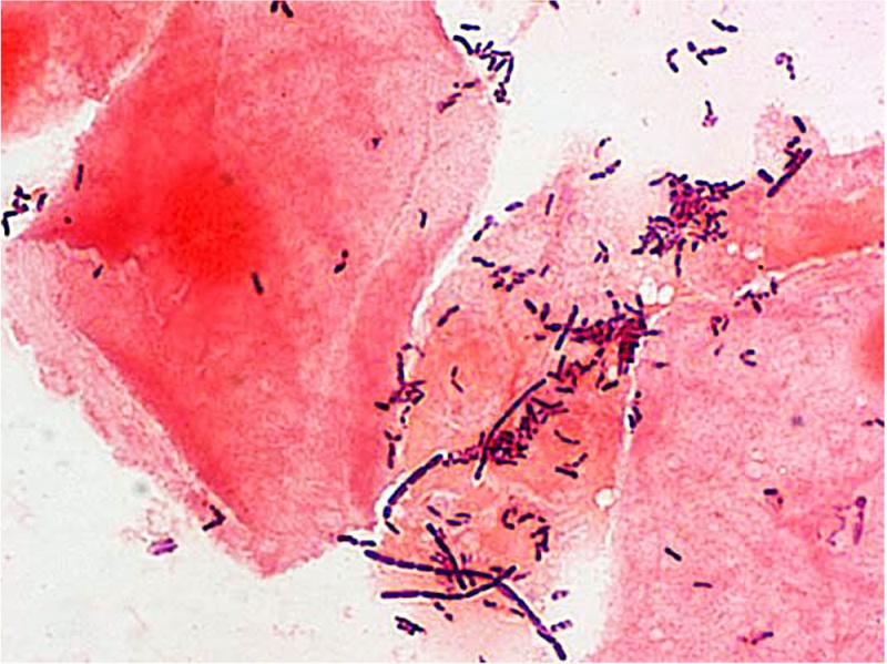 File:Bacteria - gram-stained vaginal smear 08.jpg