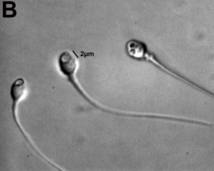 File:Human- vacuolated spermatozoa.jpg