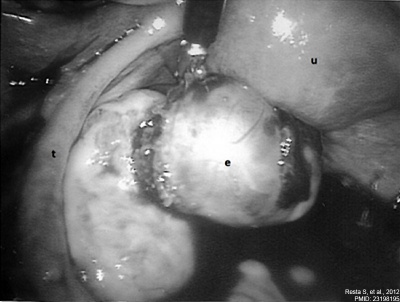 Ovarian ectopic pregnancy 01.jpg