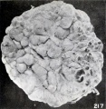 Fig. 217. Interior of the chorionic vesicle showing subchorial hematomata. No. 1495d. X0.77.