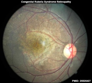 Congenital rubella syndrome retinopathy