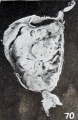 Fig. 70. Unilateral maceration bleb on cord. No. 1523. X0.5.