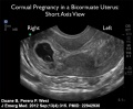 Bicornuate uterus ectopic movie icon.jpg