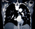 CT lungcancer.JPG