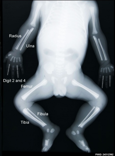 Fetal limb X-ray-01.jpg