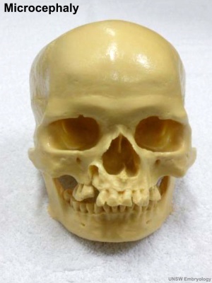 Skull microcephaly