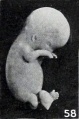 Figs. 52-63. Illustrating the absence of fundamental differences between the group of fetus compressus and grade 3 of the normal specimens. No. 651a (fig. 58) pathological. XI.