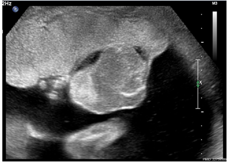 File:Placental chorioangioma ultrasound 01.jpg