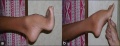Z3294943 - Relevant clinical image to group project. Includes reference, copyright and student disclaimer. Legend includes some description for peer teaching. Could have provided more information about how this deformity is generated.