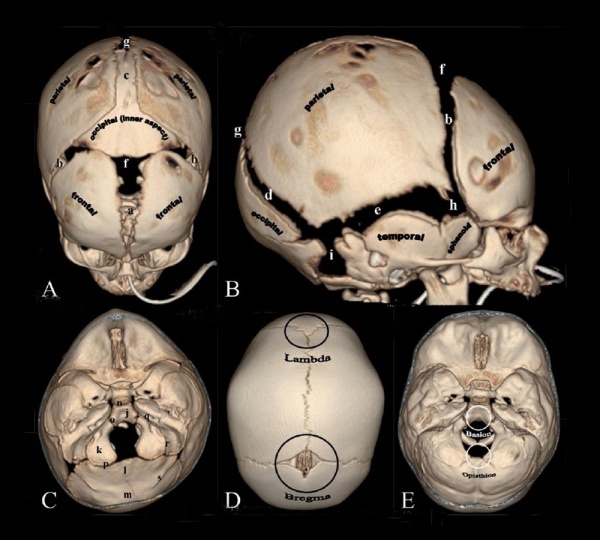sutures in skull. Skull CT normal sutures.jpg