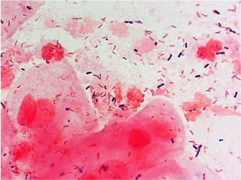 File:Bacteria - gram-stained vaginal smear 09.jpg