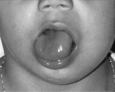 Beckwith-Wiedemann syndrome macroglossia.jpg