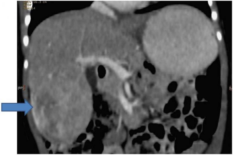File:Mosaic Trisomy 18 hepatoblastoma CT.jpg