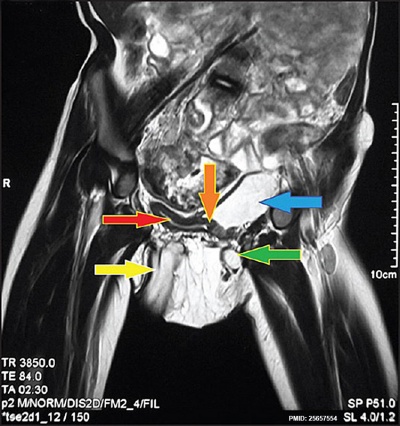 Neonatal duplicated bladder MRI