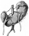 Horseshoe kidneys with asymmetric halves.