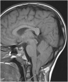 Fig 27 Cerebellar tonsils herniation on magnetic resonance imaging Z5018156